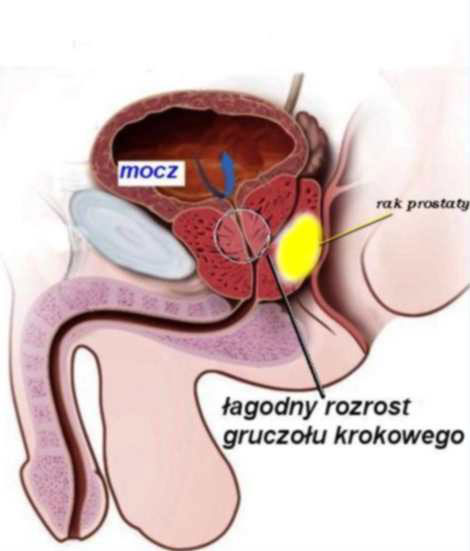 złośliwy rak prostaty forum)