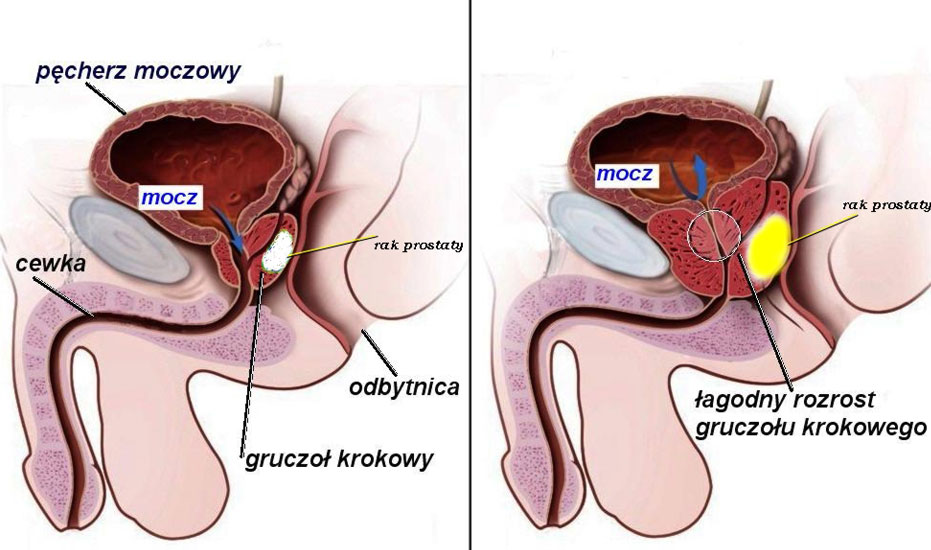 Rak Prostaty Szczecin