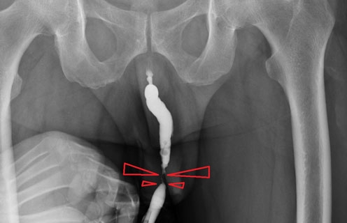 Nacięcie zwężenia cewki - uretrotomia optyczna